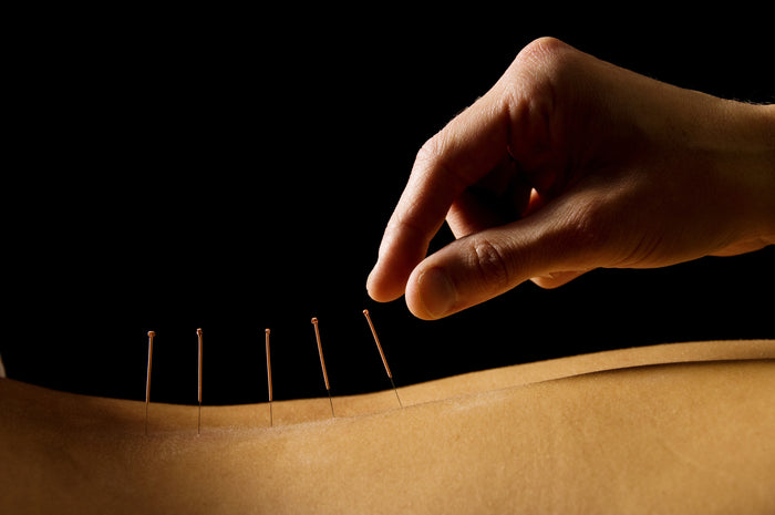 Why You Want to Use Acupuncture for Workout Recovery